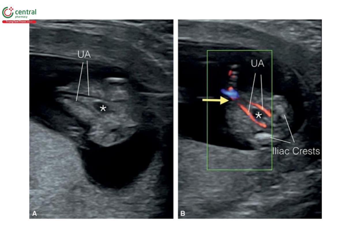 Hình 12.6: Mặt cắt ngang-chếch bụng dưới thai nhi 13 tuần tuổi trên siêu âm 2D (A) và Doppler màu (B) cho thấy bàng quang chứa đầy dịch (dấu hoa thị), được bao quanh bởi động mạch rốn trái và phải (UA). Mặt cắt này được thấy rõ nhất với Doppler màu (B), cũng có thể giúp xác nhận thành bụng nguyên vẹn (mũi tên). Lưu ý, vị trí mào chậu (iliac crests) phía sau ở B.