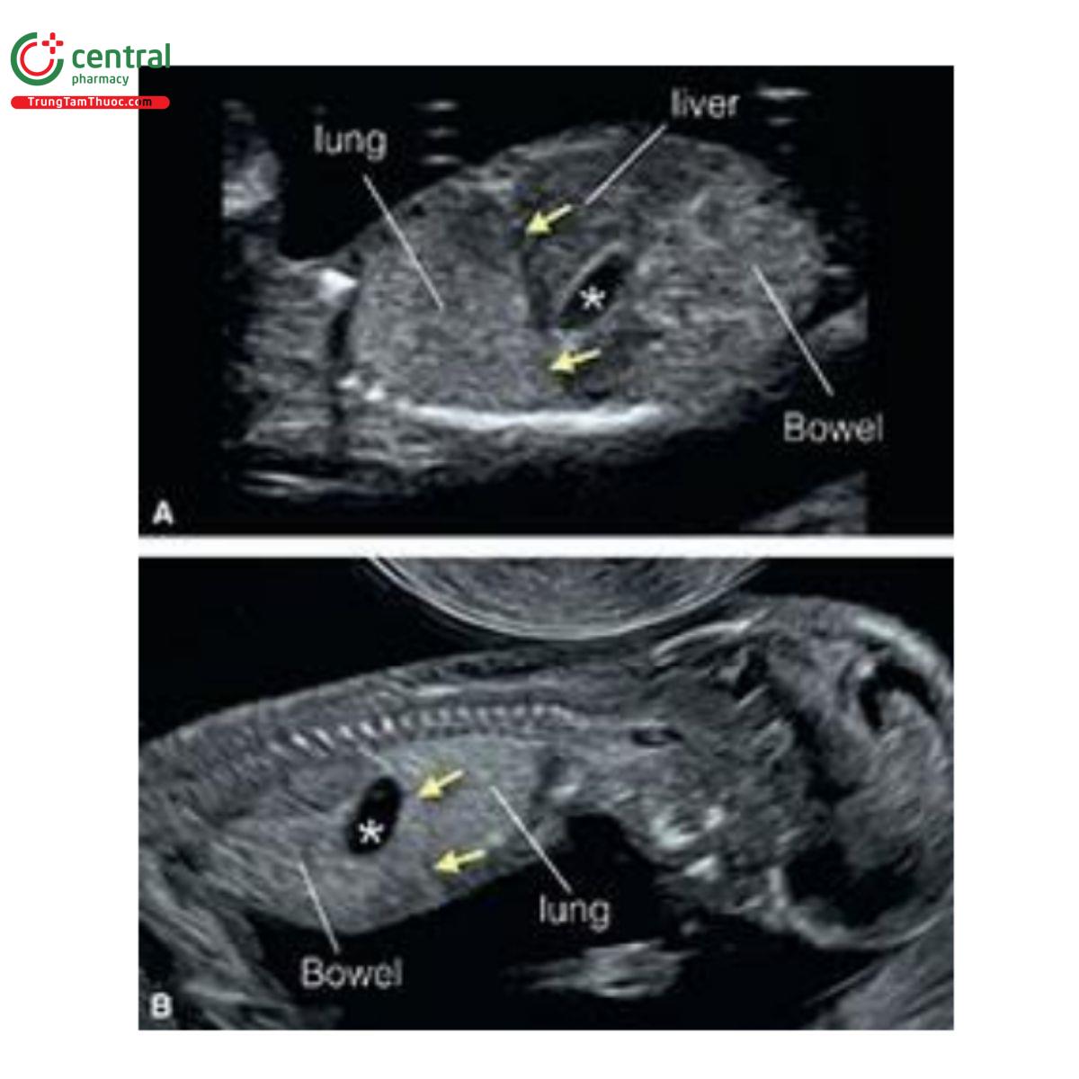 Hình 12.7: Mặt cắt dọc bên ở 2 thai nhi 13 (A) và 12 (B) tuần tuổi cho thấy ngực và bụng. Dạ dày chứa đầy dịch (dấu hoa thị) dưới cơ hoành (các mũi tên). Thai nhi A ở tư thế nằm ngửa và thai nhi B ở tư thế nằm sấp. Lưu ý, phổi và ruột tăng âm, gan giảm âm, dạ dày và bàng quang trống âm (không hiển thị trên hình). 