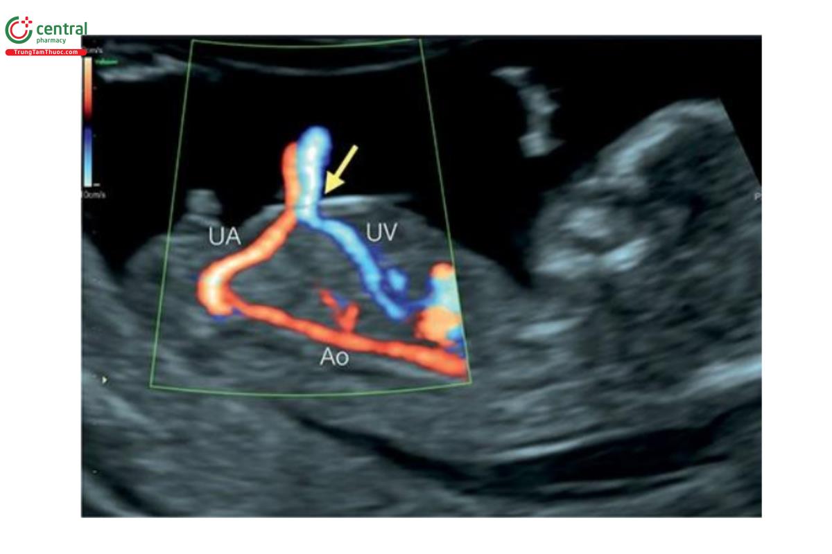 Hình 12.8: Mặt cắt dọc giữa của thai nhi 13 tuần tuổi với Doppler màu cho thấy dây rốn đi ra từ ổ bụng (mũi tên) với động mạch rốn (UA) và tĩnh mạch rốn (UV). Ao, động mạch chủ xuống.