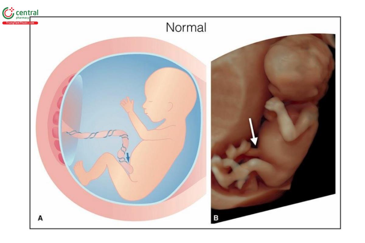 Hình 12.9: Hình vẽ minh họa (A) và hình ảnh siêu âm 3D tương ứng ở chế độ bề mặt của thai nhi 12 tuần tuổi. Lưu ý, dây rốn cắm vào bụng bình thường ở A và B (mũi tên).