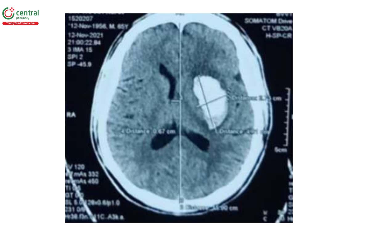 Hình ảnh 1: Chảy máu não trên phim chụp CLVT sọ não của người bệnh tại Bệnh viện Bạch Mai.