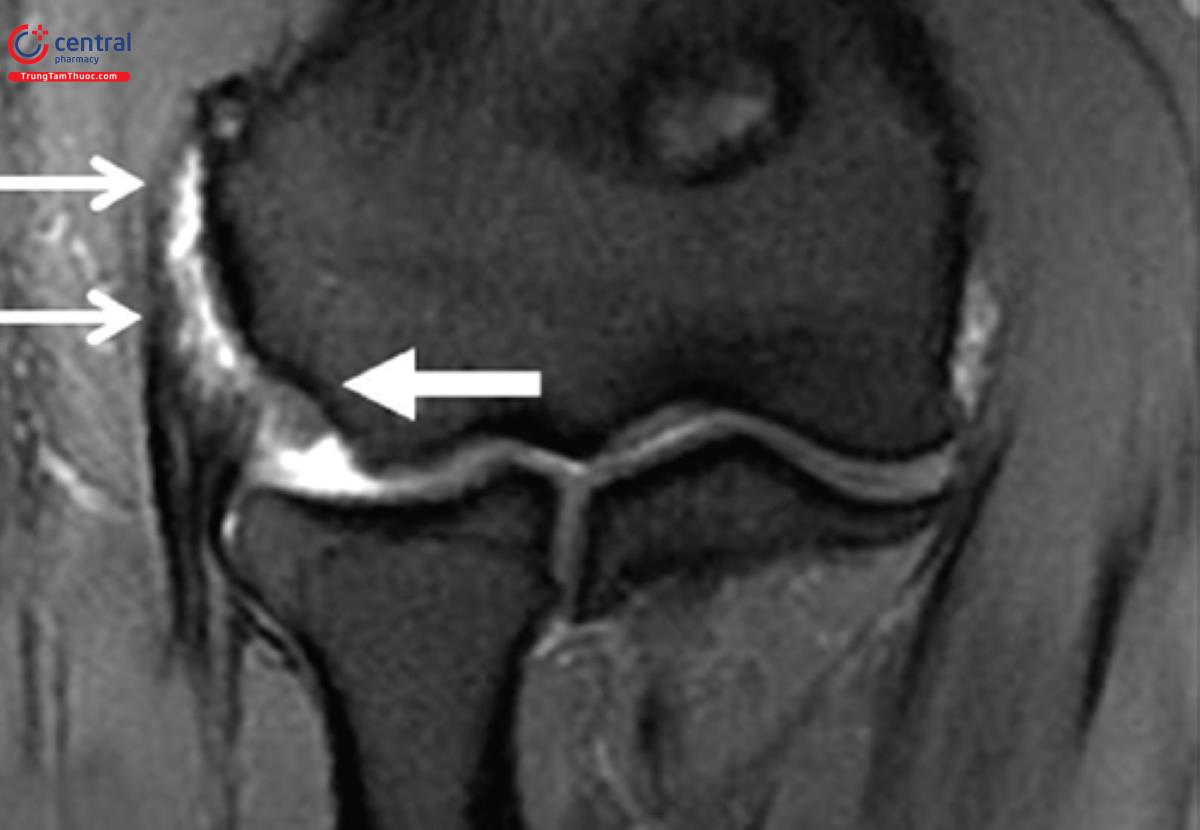Chụp MRI cho thấy dịch lỏng trong gân của khuỷu tay (Nguồn ảnh tham khảo) 