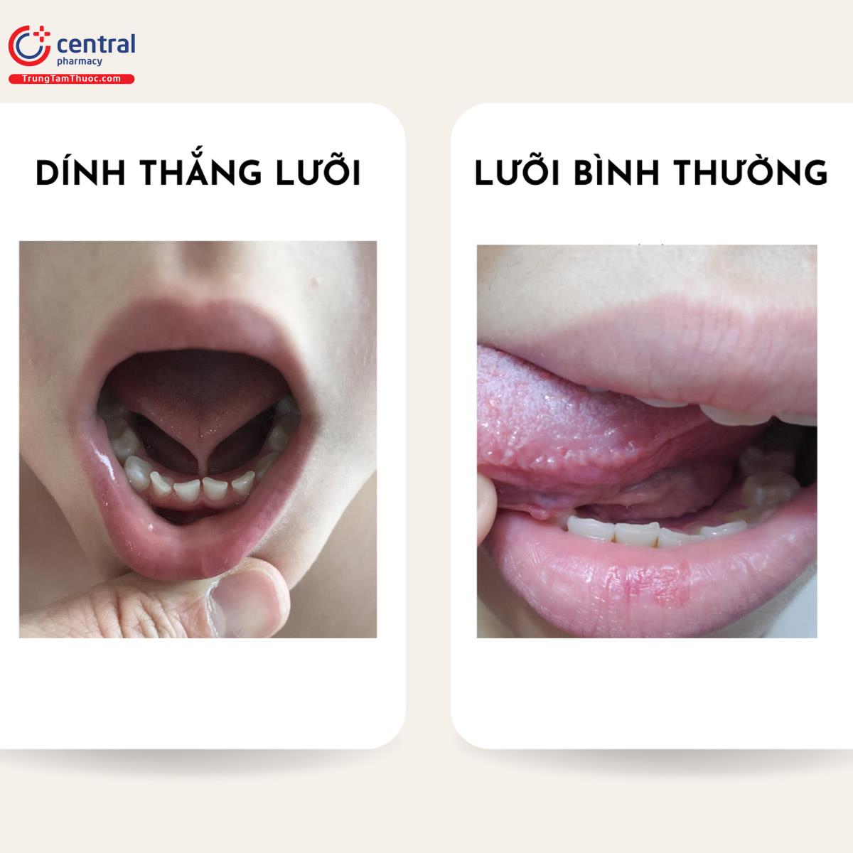 Hình ảnh lưỡi bình thường và dính thắng lưỡi