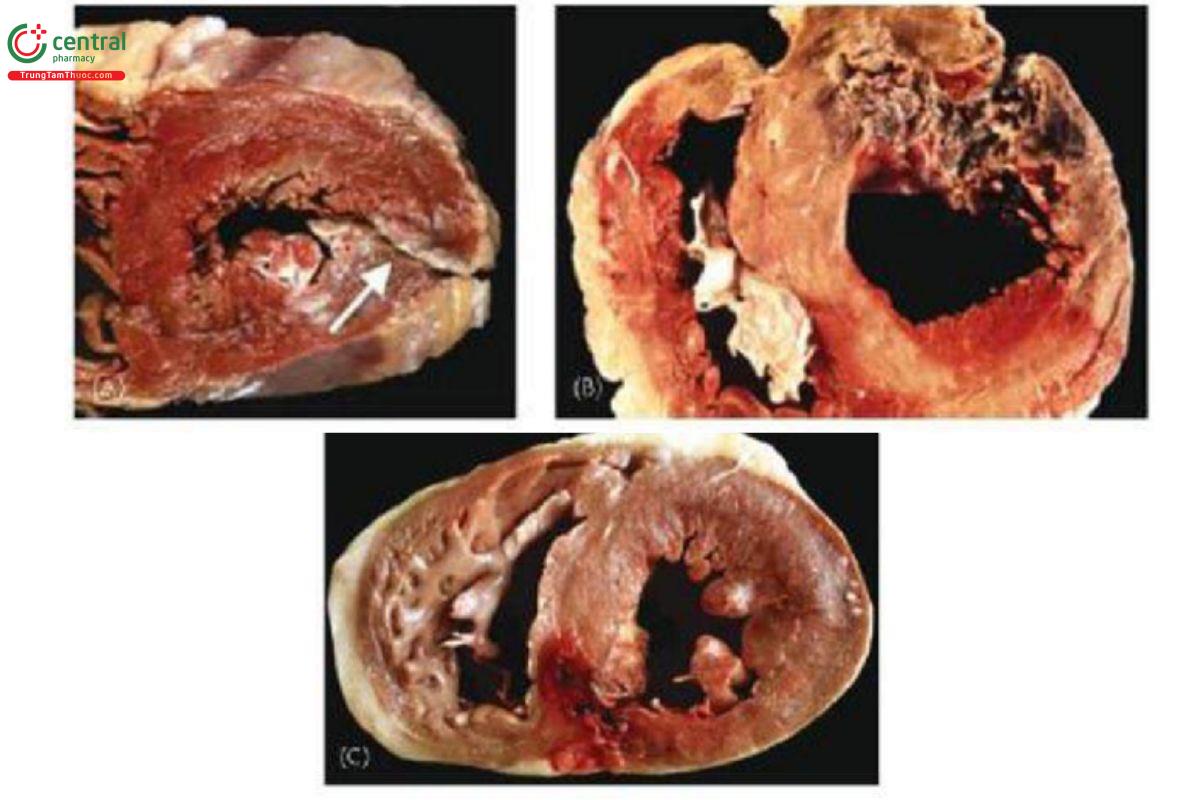 Hình 1. (A) Vỡ toạc thành bên thất trái; (B) Thủng thành trước thất trái với hoại tử cơ tim và huyết khối; (C) Thủng không hoàn toàn thành sau thất trái.