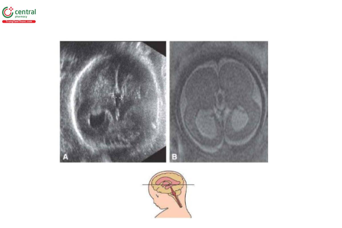 Hình 10–11. Não phẳng ở thai nhi 33 tuần tuổi. Các mặt cắt ngang trên siêu âm qua thành bụng (A) và MRI (B) không thấy rãnh não với vỏ não dày và giãn não thất nhẹ hình giọt nước. Lưu ý, “não hình số 8” trên hình ảnh MRI.