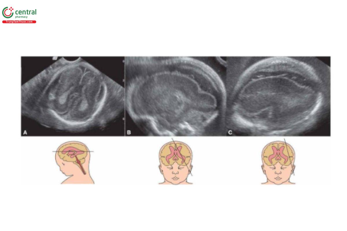 Hình 10–12. Não phẳng di truyền lặn trên nhiễm sắc thể thường lúc 22 (A) và 25 tuần tuổi (B, C). Hai đứa trẻ trước đó được sinh ra với không có hồi não và đa dị tật. Lúc 22 tuần tuổi, không thấy rãnh Sylvius và hình dạng não bất thường nhưng chỉ đến 25 tuần tuổi, mới thấy rõ rãnh não bất thường.