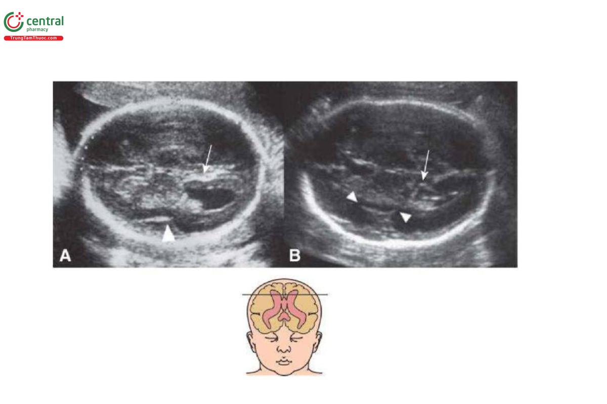 Hình 10–7. Mặt cắt ngang não thất qua thành bụng ở thai nhi 27 tuần tuổi được chẩn đoán sau sinh mắc hội chứng Miller-Dieker (MDS) (A) và ở thai nhi bình thường với cùng tuổi thai (B). Các mũi tên cho thấy sự khác biệt về hình dạng giữa các rãnh đỉnh-chẩm và các đầu mũi tên cho thấy sự khác biệt giữa rãnh thái dương phát triển tốt tạo thành thùy đảo ở B và rãnh Sylvius nông giống như thai nhi từ 18 đến 20 tuần tuổi ở A. Lưu ý, kích thước não thất bên bình thường giáp biên (borderline) ở thai nhi MDS.