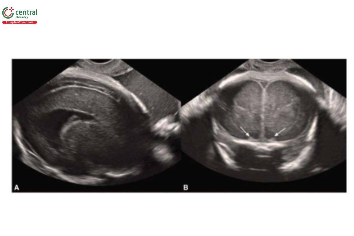 Hình 10–8. Mặt cắt dọc (A) và vành (B) qua ngả âm đạo lúc 34 tuần tuổi ở thai nhi mắc hội chứng Mille-Dieker không được chẩn đoán trong các lần siêu âm trước đó. Không thấy rãnh và hồi não, đồng thời rãnh khứu kém phát triển (mũi tên)
