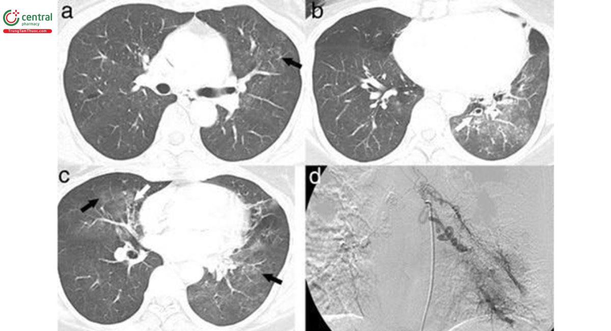 Hình 1. Các tổn thương kính mờ trên bệnh nhân ho ra máu (các mũi tên). Phần tổn thương kính mờ tại thùy dưới phổi (T) là ưu thế nhất, xác định vị trí xuất huyết [9].