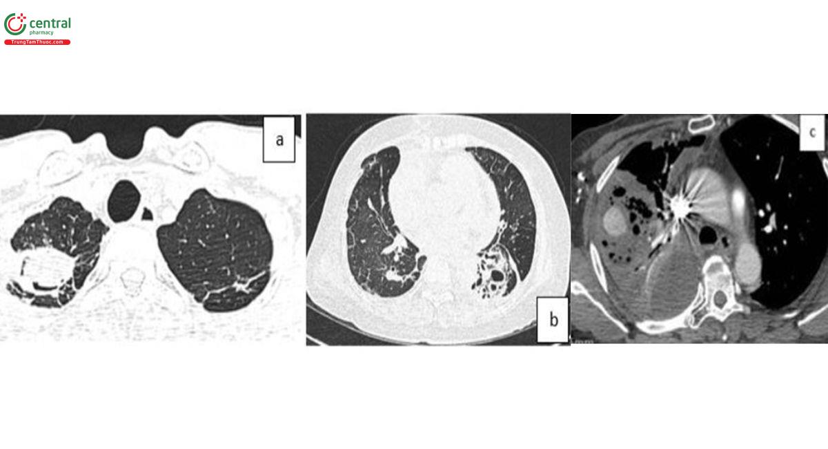 Hình 2. Hình CT scan ngực gợi ý căn nguyên ho máu: a) Hình ảnh quả cầu nấm. b) Giãn phế quản dạng túi. c) Viêm phổi hoại tử có giả phình mạch. (Nguồn: Bệnh viện Chợ Rẫy).