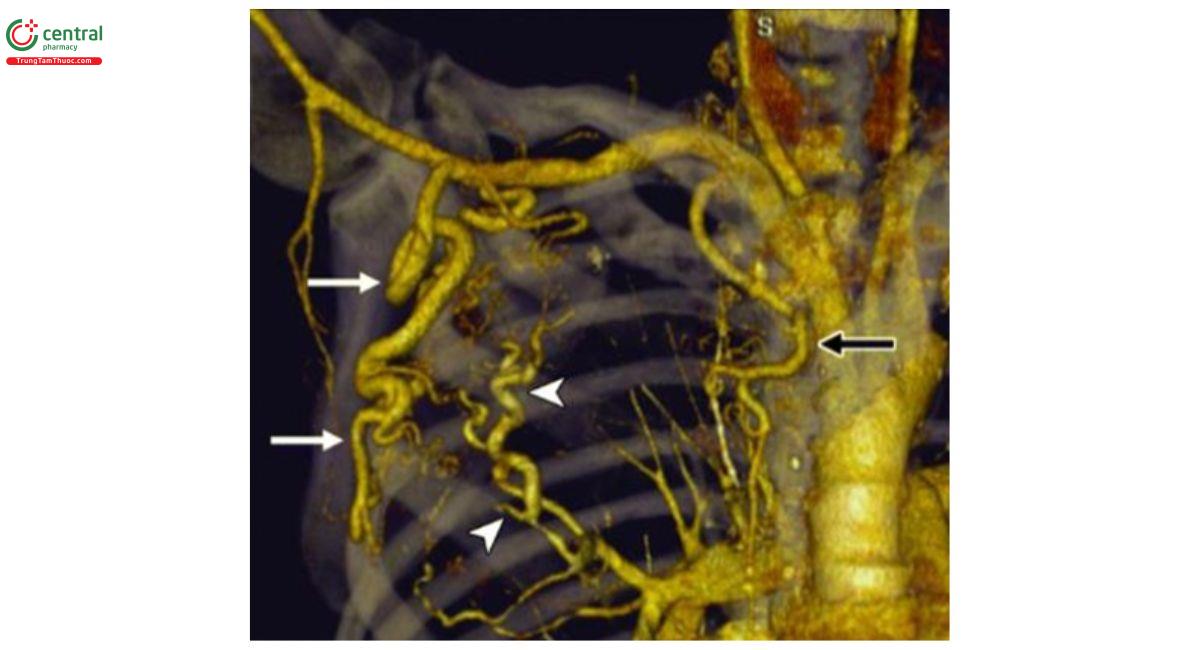 Hình 3. Hình chụp VRT mạch máu giúp xác định gốc động mạch phế quản [8].