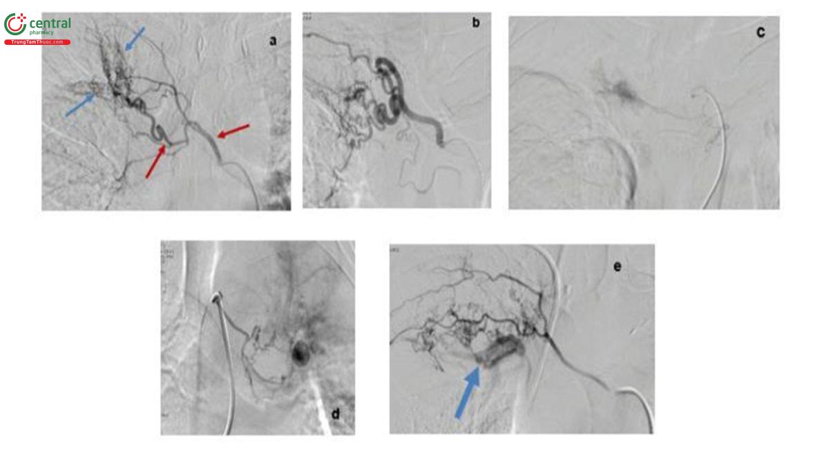 Hình 4. Các dấu hiệu bệnh lý trên chụp mạch số hóa xóa nền (Nguồn: Bệnh viện Chợ Rẫy)