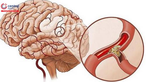 Hình 2: Tổn thương não do tắc mạch máu não