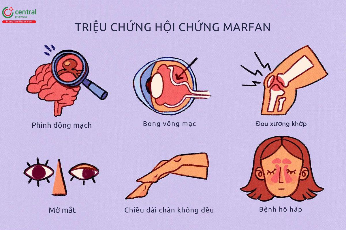 Triệu chứng hội chứng Marfan 