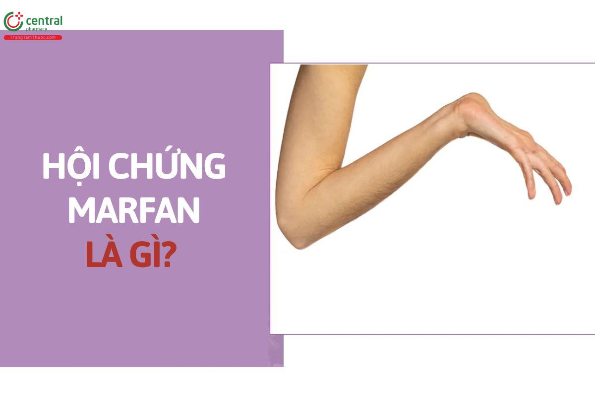 Hội chứng Marfan là gì?