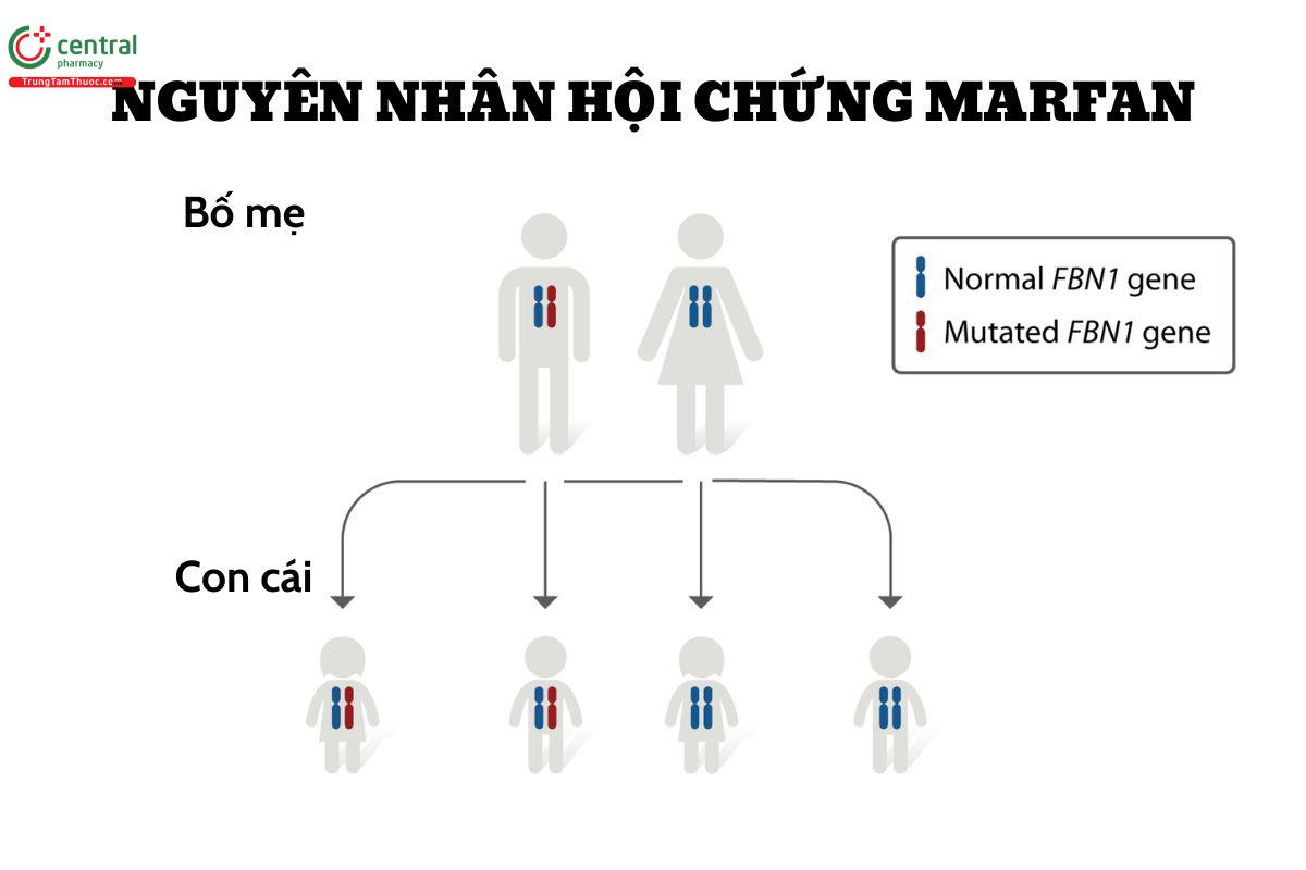 Nguyên nhân hội chứng Marfan 