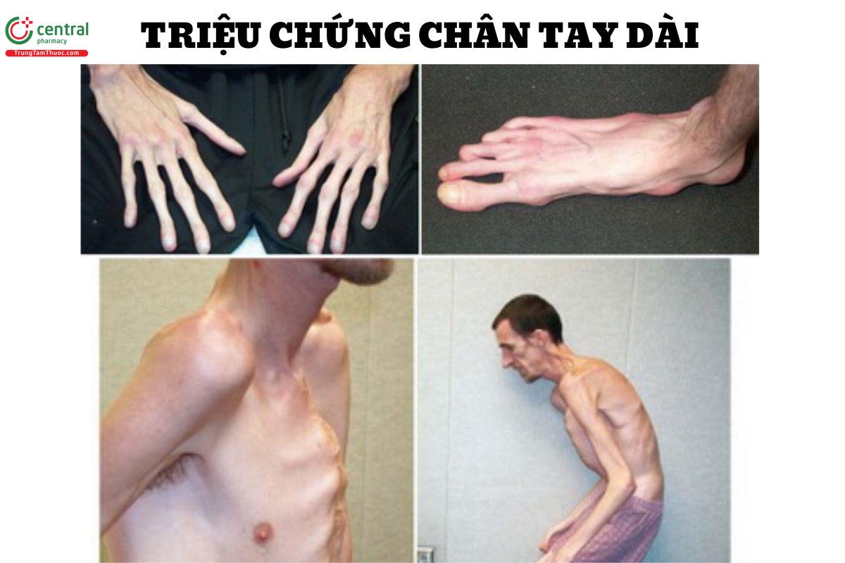 Triệu chứng chân tay dài hội chứng Marfan 