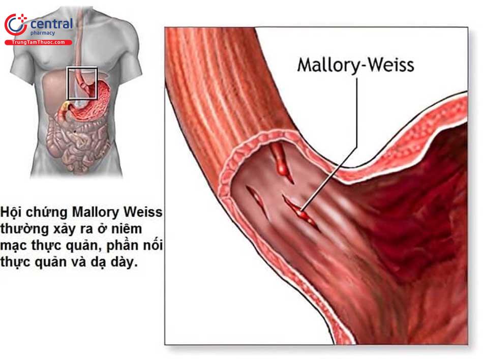 Hội chứng Mallory-Weiss là gì?