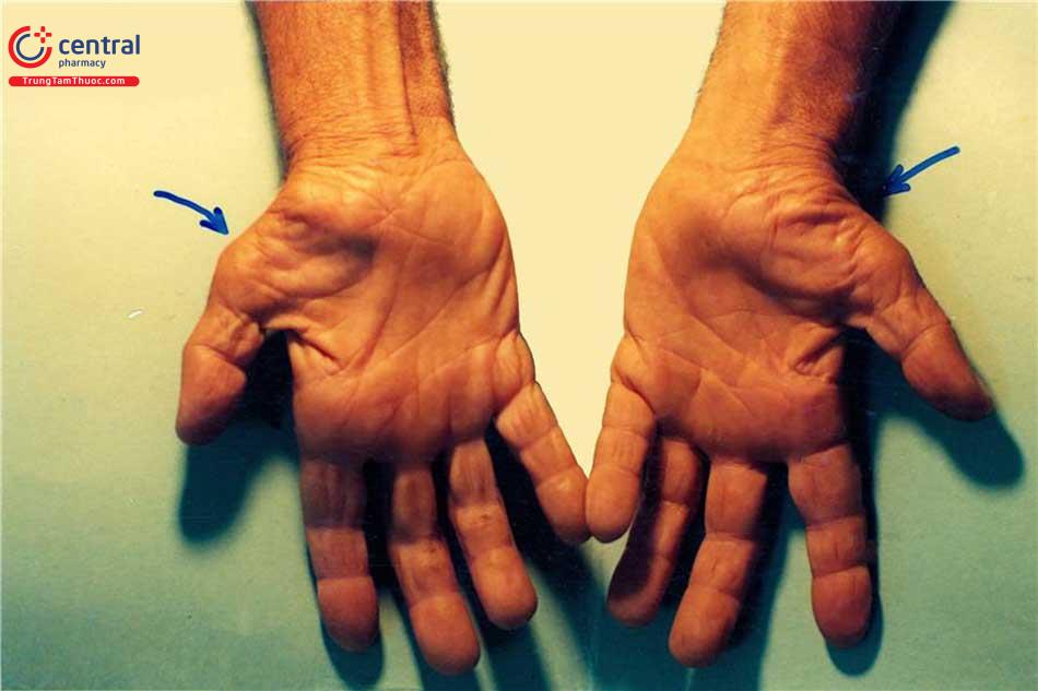 Hình ảnh đôi bàn tay biến dạng do hội chứng ống cổ tay