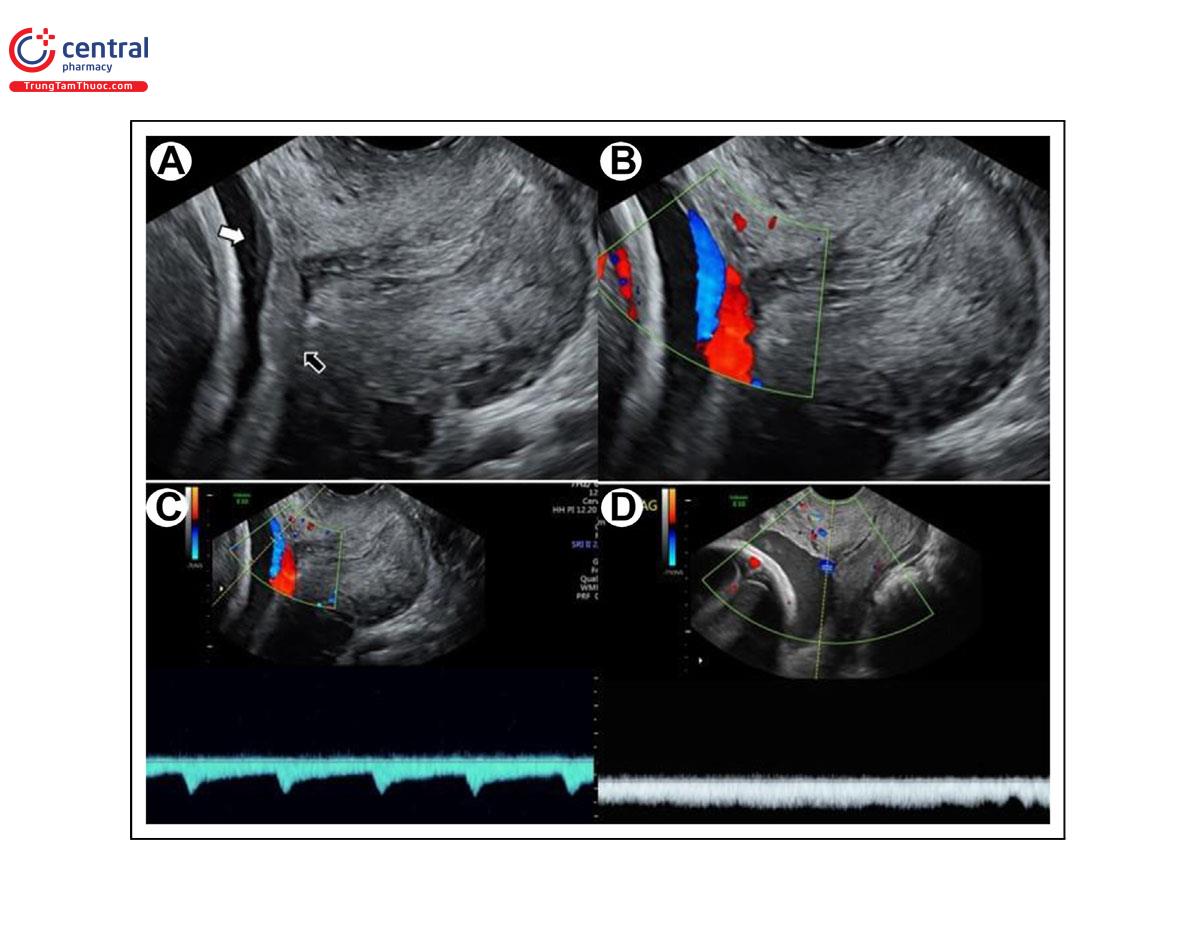 Hình 1. Mạch máu tiền đạo. (A) Các mạch máu thai nhi được nhìn thấy trong các màng nằm trên lỗ trong cổ tử cung, bao gồm động mạch (mũi tên trắng) và tĩnh mạch (mũi tên đen). (B) Trong trường hợp này, trên Doppler màu, động mạch có màu xanh và tĩnh mạch có màu đỏ. (C) Doppler xung cho thấy dòng chảy động mạch tương ứng với nhịp tim thai nhi. (D) Ở một trường hợp khác, Doppler xung cho thấy dòng chảy tĩnh mạch với tĩnh mạch (Doppler màu xanh) nằm trên lỗ trong cổ tử cung.