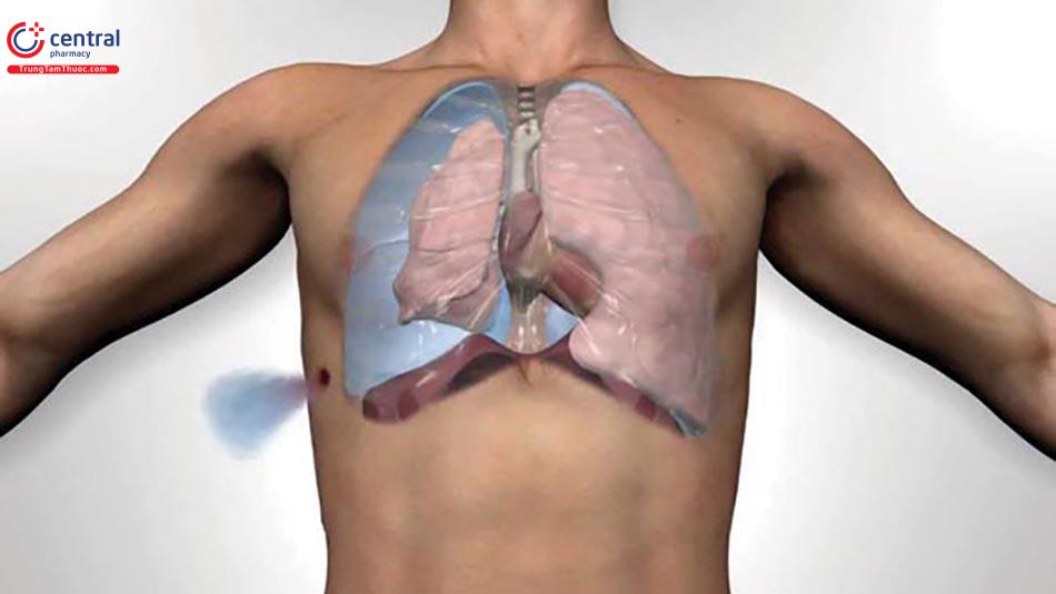 Điều trị bệnh bằng cách hút khí màng phổi
