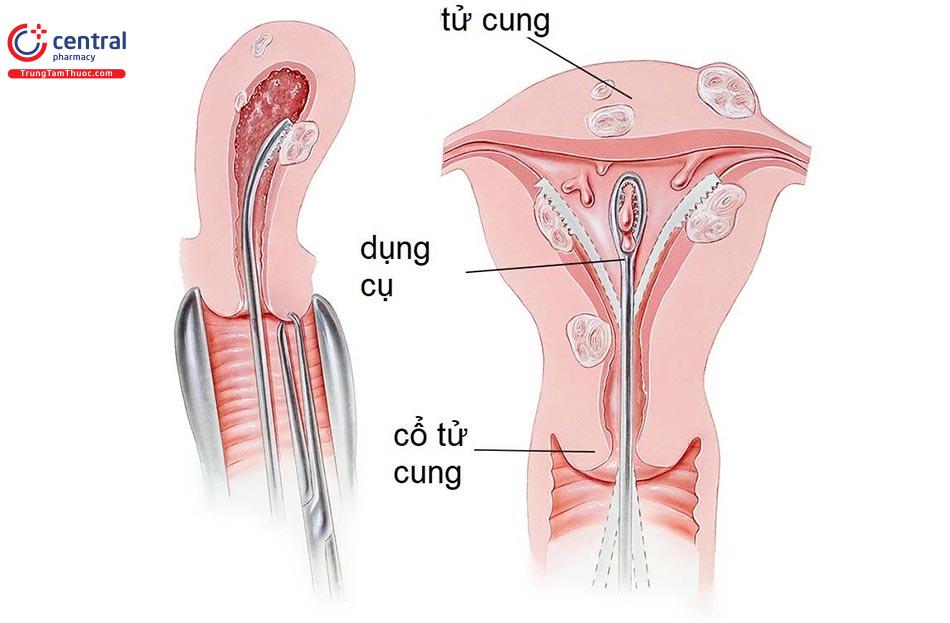 Hút nạo buồng tử cung