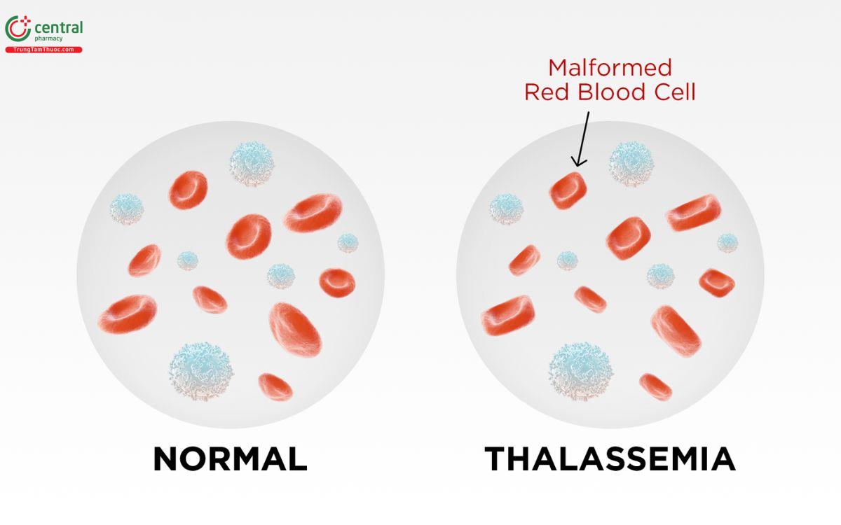 So sánh hồng cầu người bình thường và người bị bệnh Thlassemia
