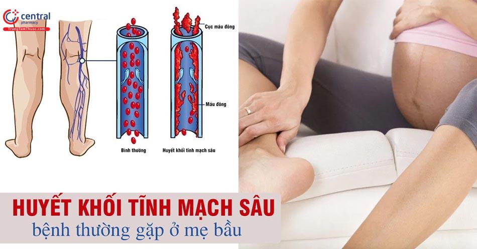 Huyết khối tĩnh mạch sâu ở bà bầu