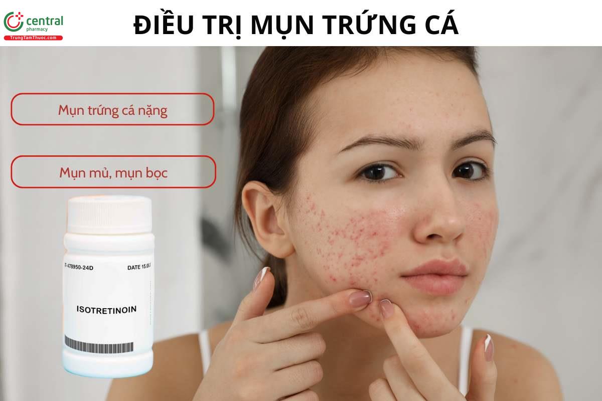 Chỉ định của Isotretinoin