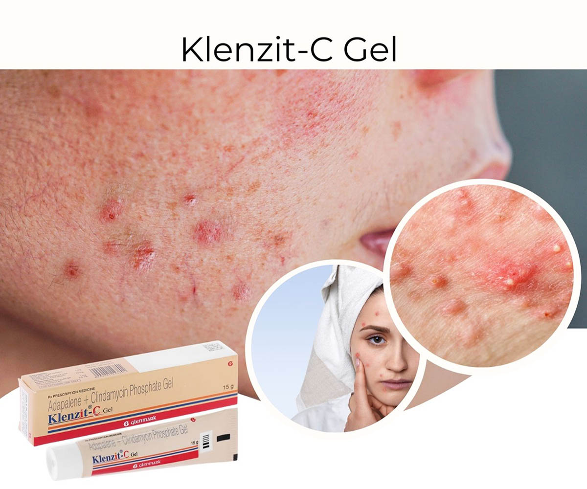 Klenzit-C Gel dùng cho mụn gì?