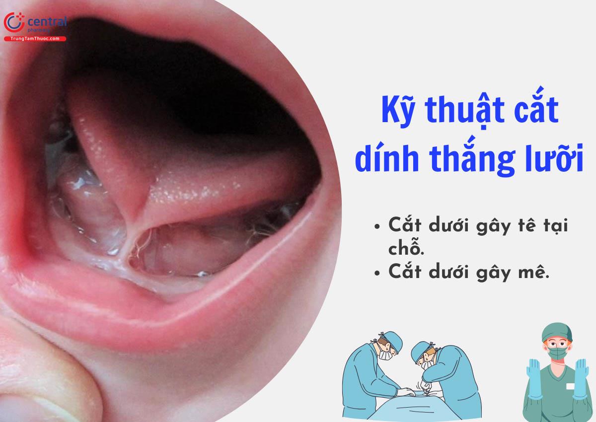 Kỹ thuật cắt dính thắng lưỡi