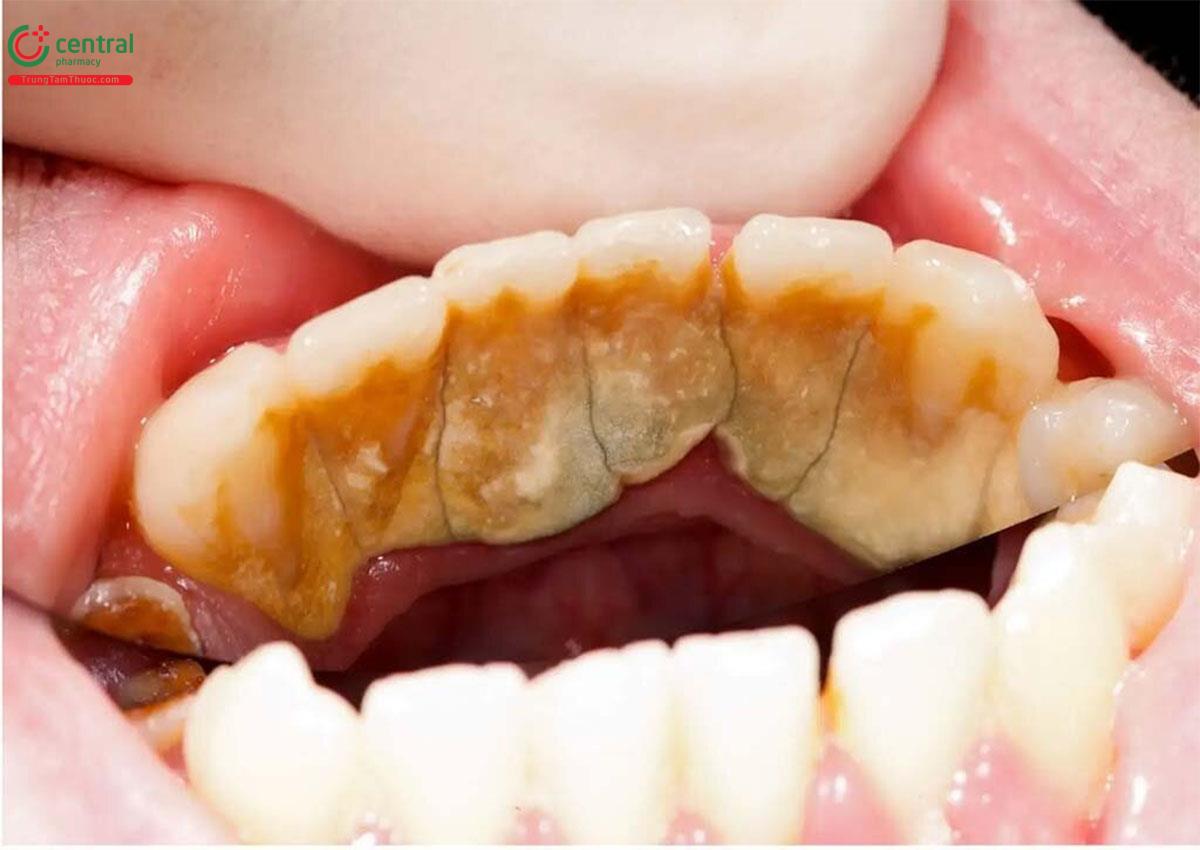 Cao răng (Vôi răng mức độ nặng)