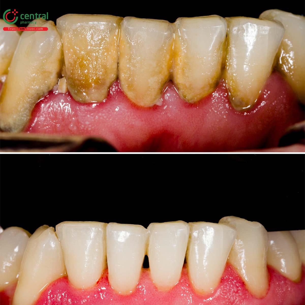 Cao răng trước và sau khi lấy