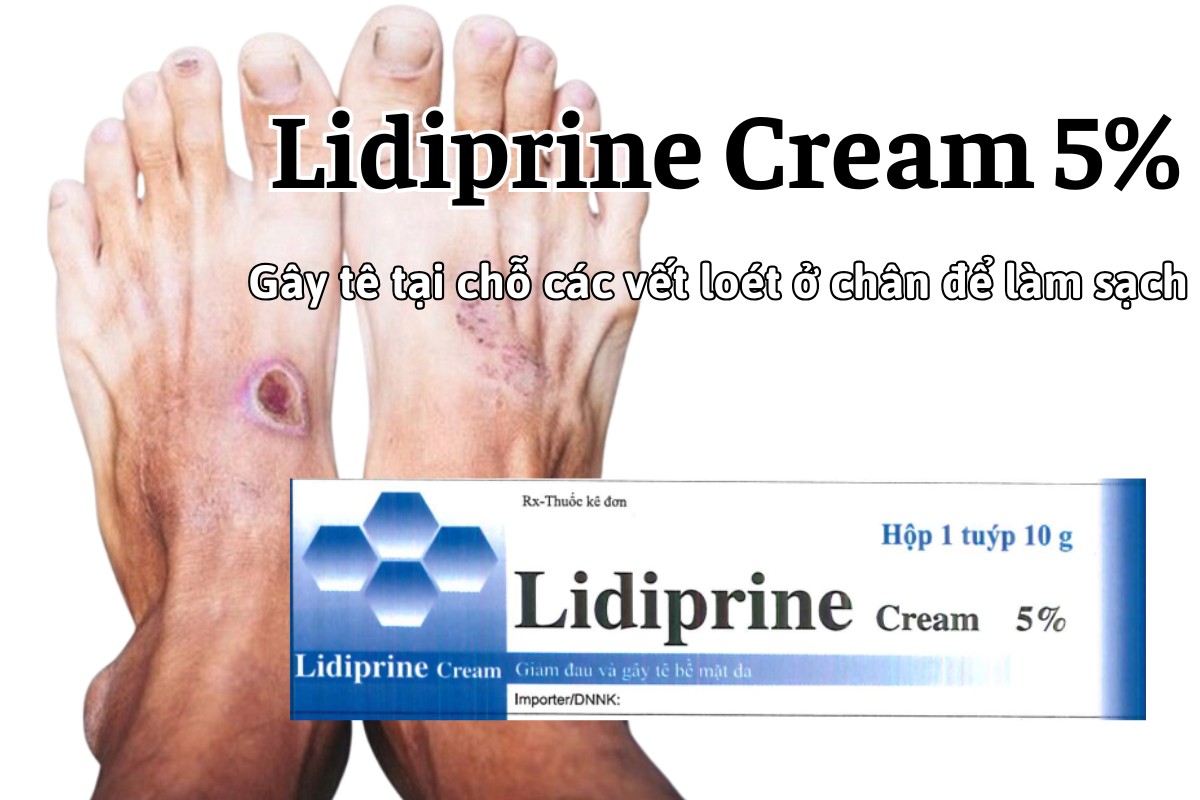 Thuốc Lidiprine Cream 5% gây tê tại chỗ các vết loét ở chân để làm sạch