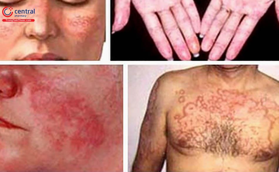Lupus ban đỏ hệ thống là bệnh tự miễn, ảnh hưởng đến đa cơ quan