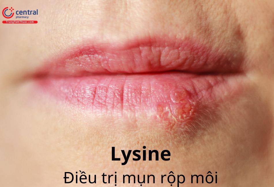 Lysine điều trị mụn rộp