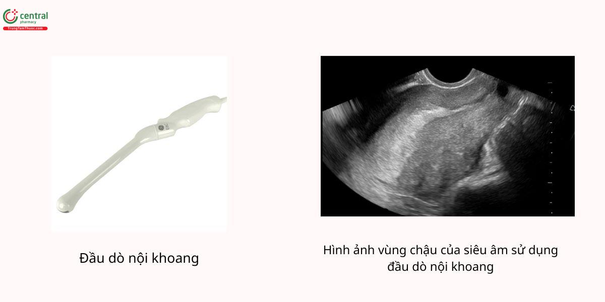 Đầu dò nội khoang và hình ảnh vùng chậu