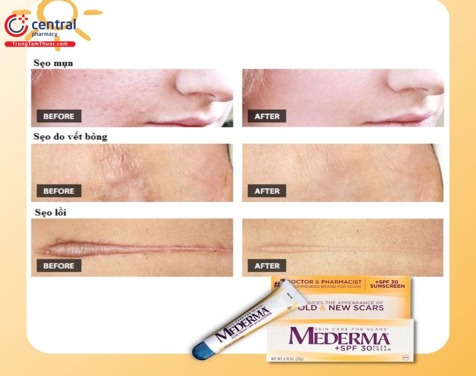 Công dụng mờ sẹo của mederma scar cream plus spf 30