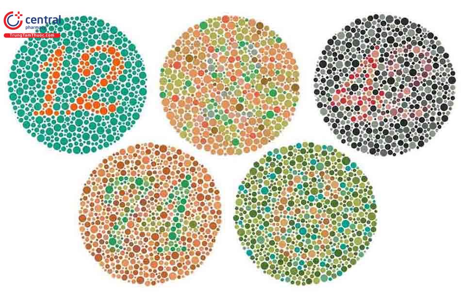 Người bị mù màu thường không nhận biết được các số trong hình