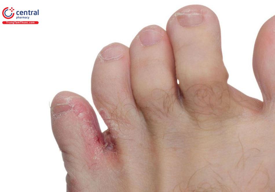 Hình ảnh người bị nấm kẽ