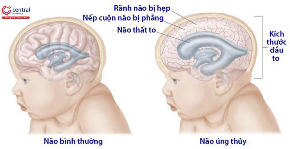 Não úng thủy là sự gia tăng của dịch não tủy trong sọ não