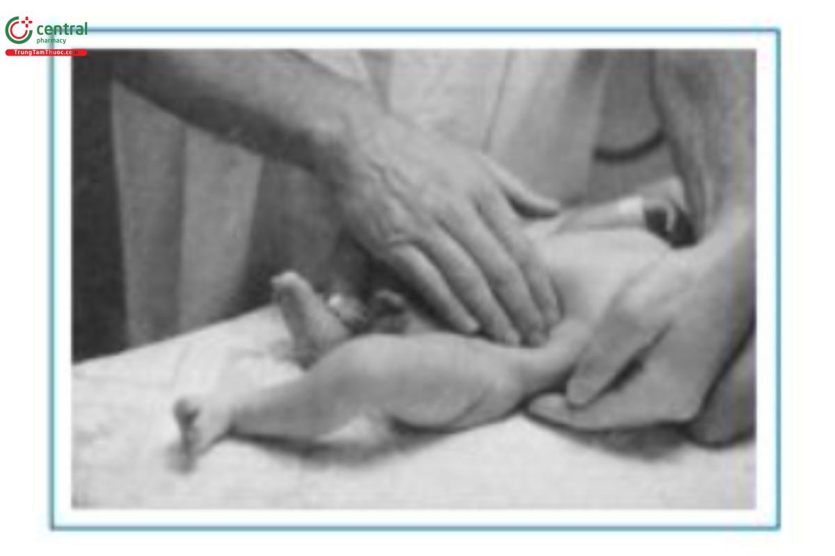 Hình 1.1 Sờ thận (bằng hai tay) Source: From Coen RW, and Koffler H. 1987. Primary Care of the Newborn.Boston, MA: Little, Brown, 30. Reprinted by permission.