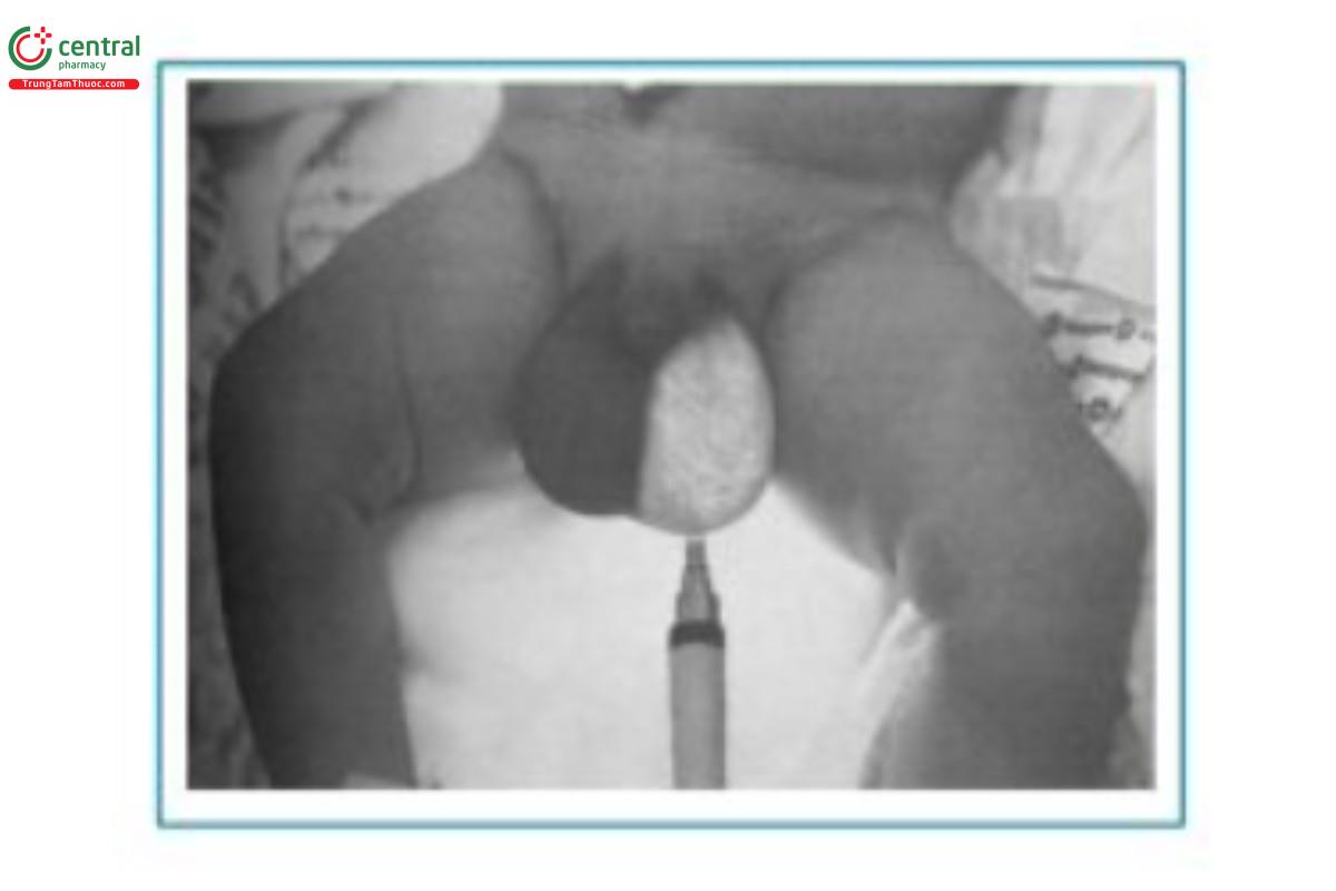 Hình 1.4 Chiếu ánh sáng trong tràn dịch màng tinh hoàn