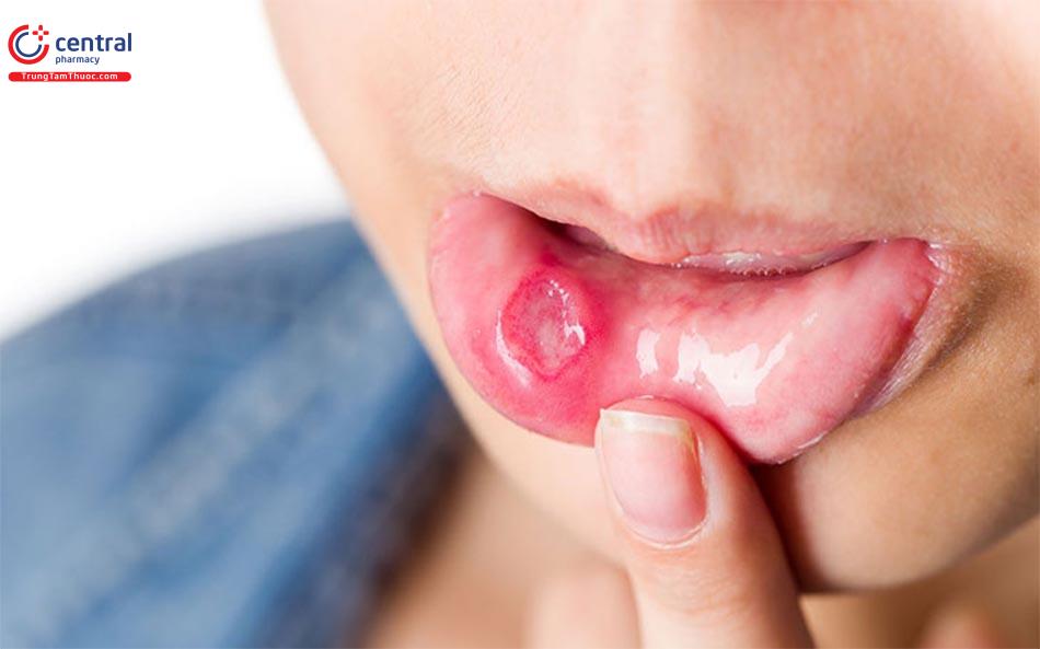 Hình ảnh người bị nhiệt miệng