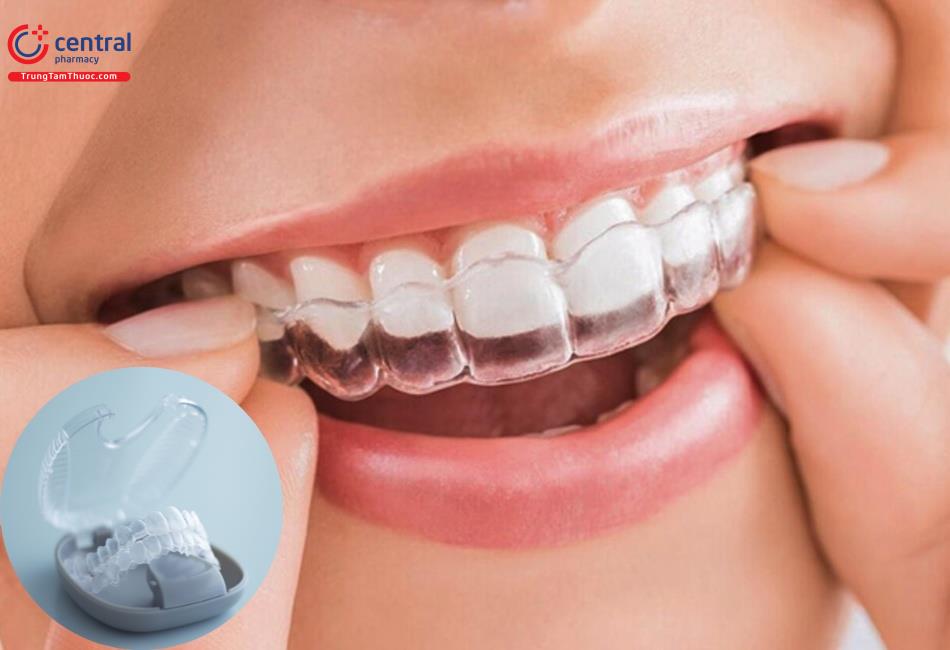 Niềng răng trong suốt invisalign có tính thẩm mỹ cao