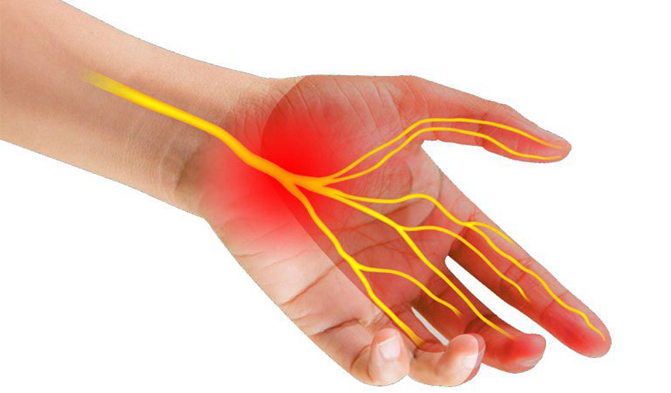 Hình ảnh minh họa hội chứng ống cổ tay