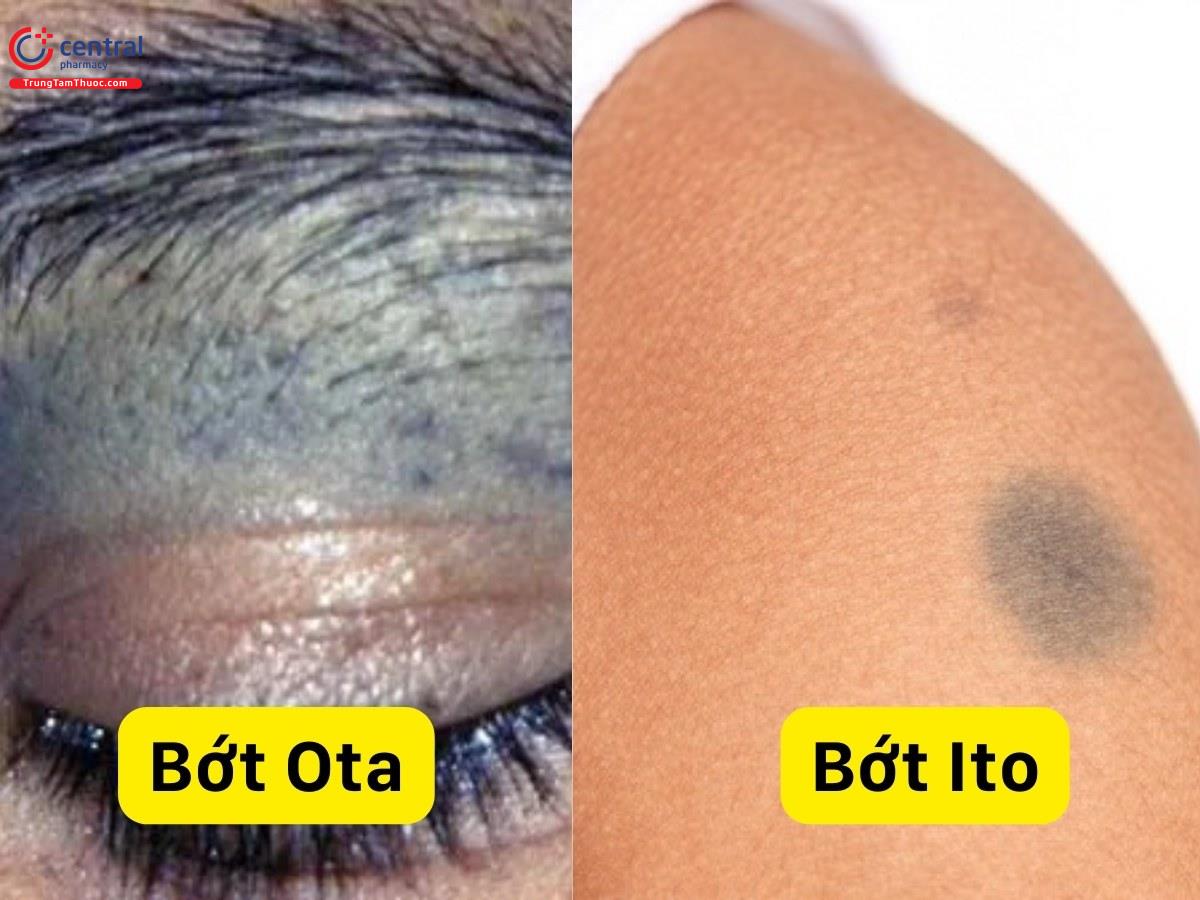 Bớt Ota khác với bớt Ito