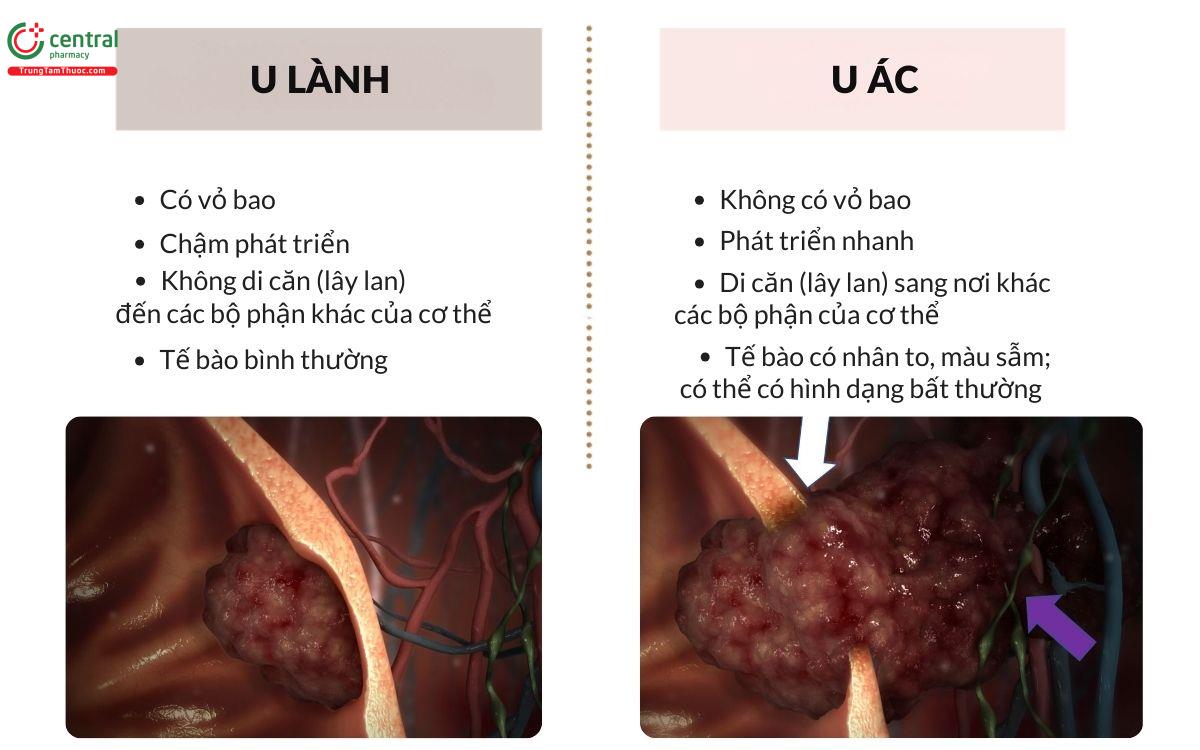 Phân biệt u lành và u ác