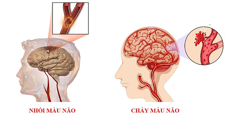 Phân loại tai biến mạch máu não