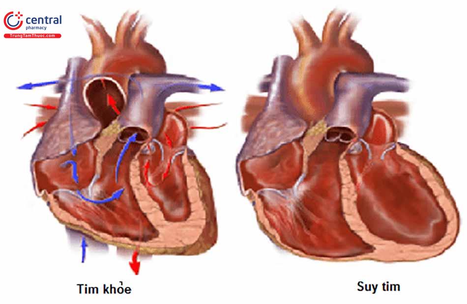 Phân loại mức độ suy tim